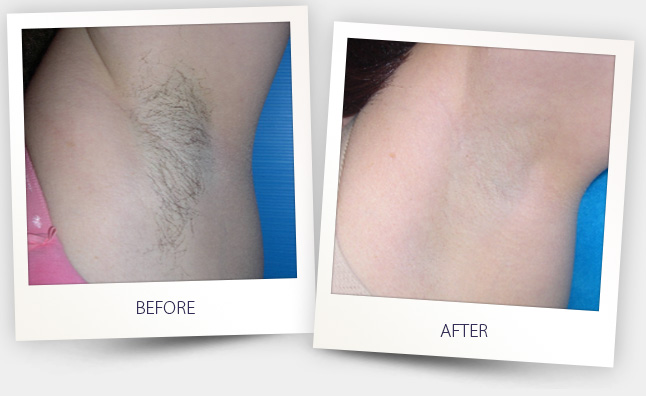 hair removal (3).jpg