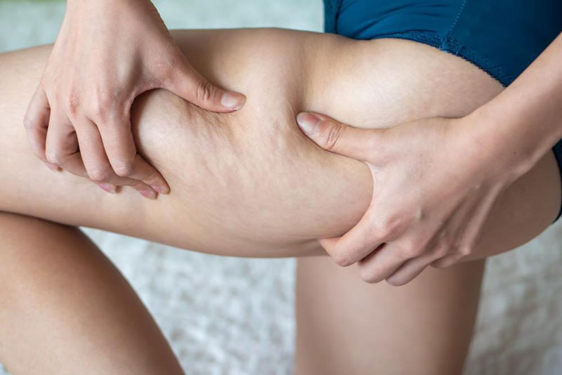 How-Long-Does-It-Take-to-See-Results-From-Velashape-Cellulite-Treatment.jpg