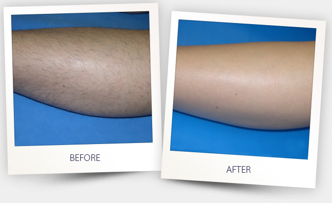 hair removal (2).jpg