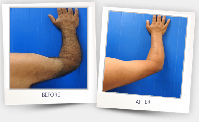 hair removal (4).jpg