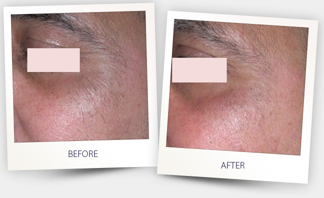 hair removal (1).jpg